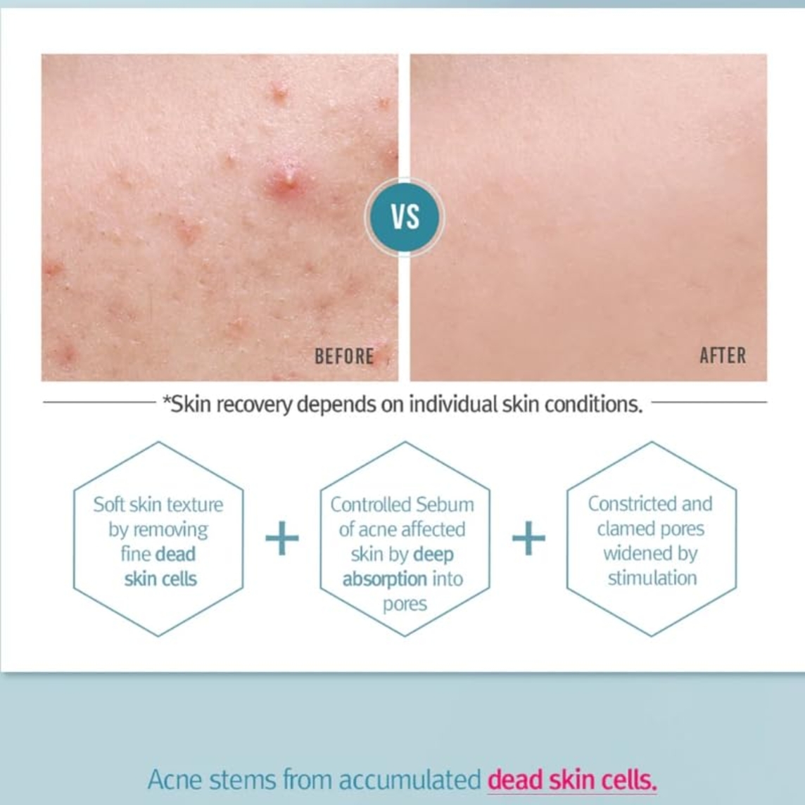 ACNE Toner