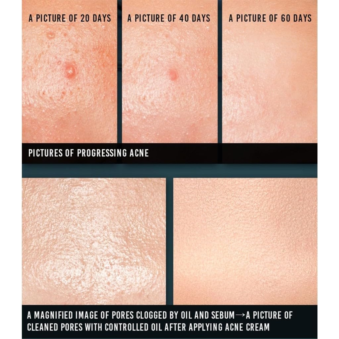 ACNE Cream