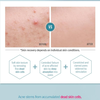 ACNE Toner