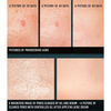 ACNE Cream